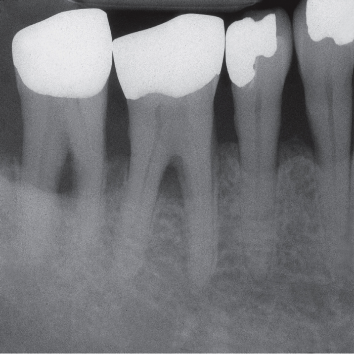 Пародонтит рентгенологическая картина